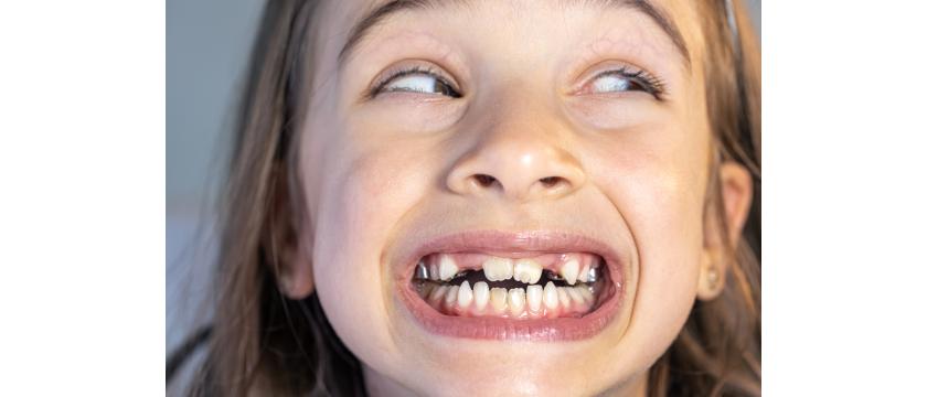 Malocclusione dentale: sintomi e rimedi