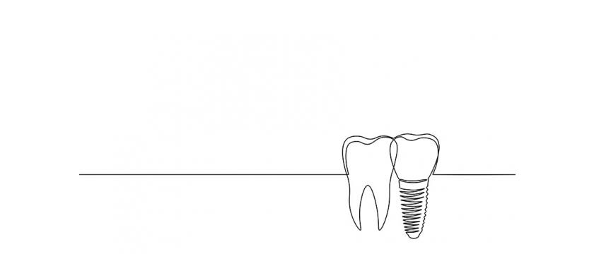 Implantologia dentale: cos'è e a cosa serve