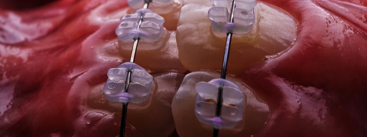 Ortodonzia con allineatori trasparenti